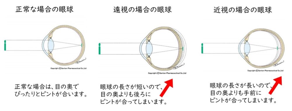 小児の弱視②弱視の原因って何?治療法は? |大阪市淀川区 阪急三国駅から徒歩約2分の眼科|おおうら眼科